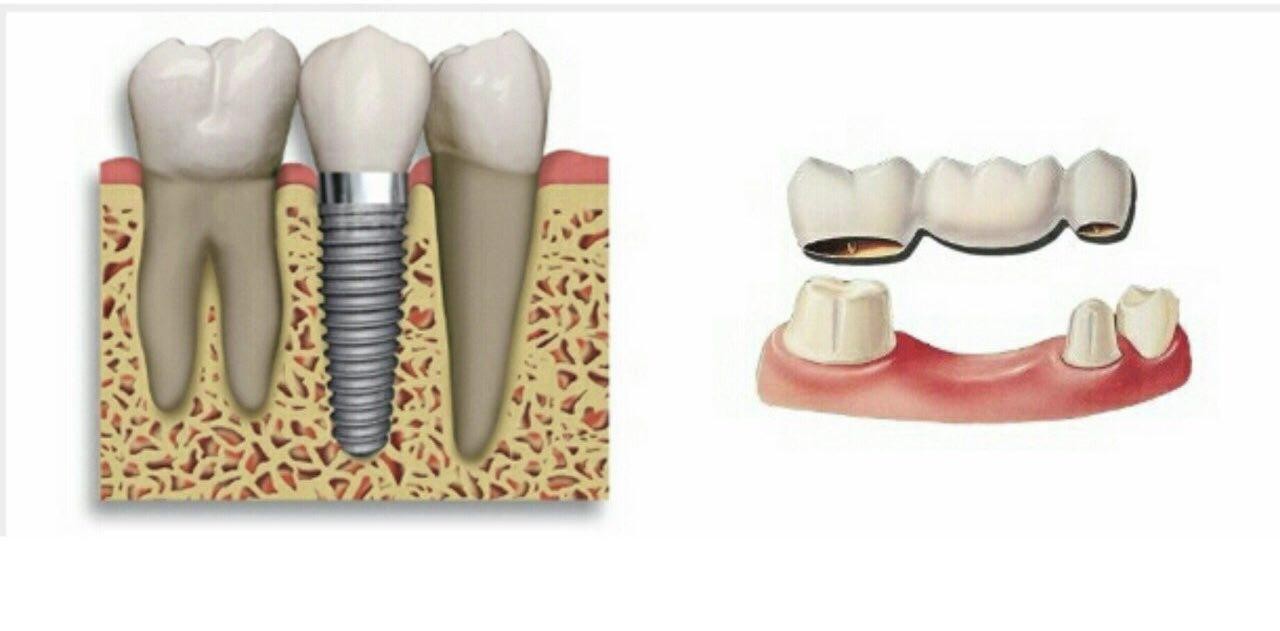 Мост на имплантах на 3. Мост на имплантах на 3 зуба. Мост на имплантах на 3 зуба минусы. Мосты с консолью на имплантах.