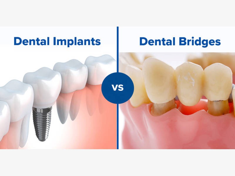 ایمپلنت یا بریج دندان، کدام روش بهتر است؟