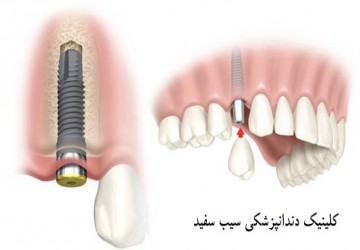 ایمپلنت تک دندان، ایمپلنت برای یک دندان