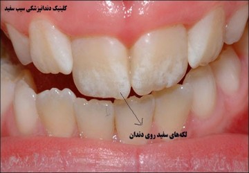 لکه‌های سفید روی دندان، علت، پیشگیری و درمان آن