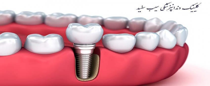 آیا ایمپلنت دندان مثل دندان طبیعی است