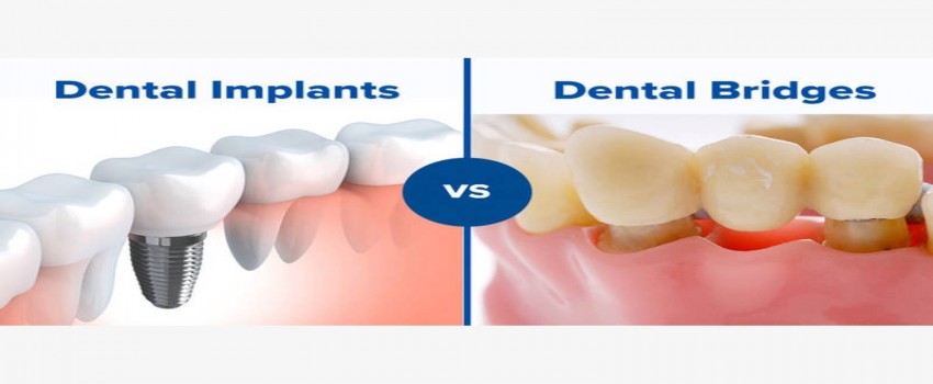 ایمپلنت یا بریج دندان، کدام روش بهتر است؟